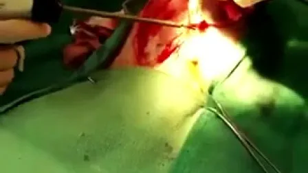 Transforaminal (Spinal) Endoscope 