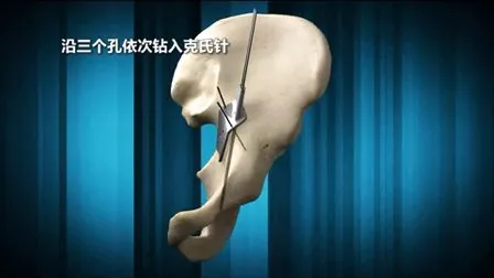 New M10 Series Spinal System, Spine Product 